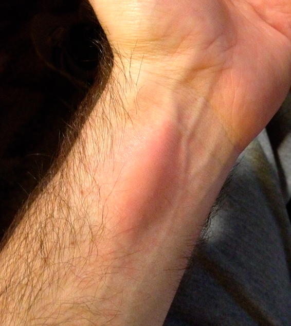 hives wrist